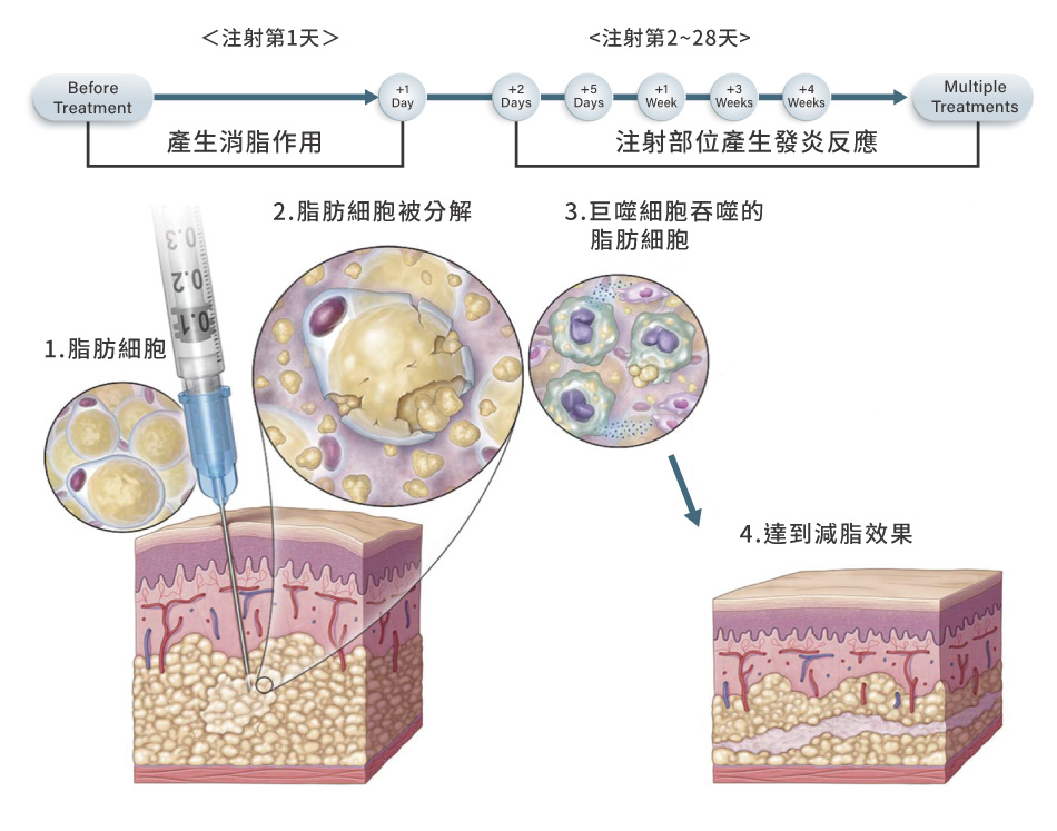 容脂注射劑的原理是什麼？